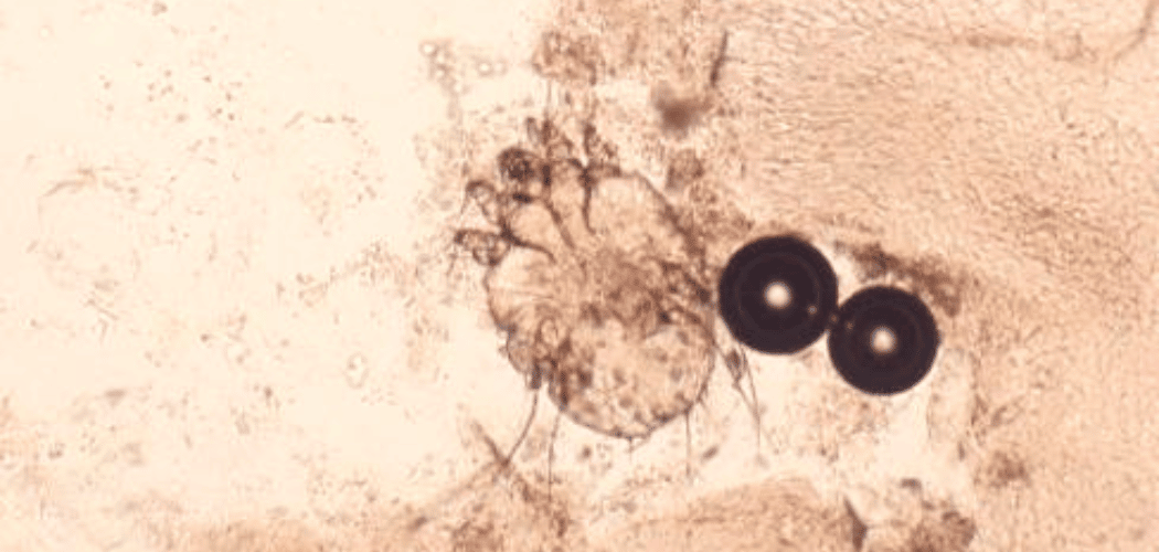 Een scabiësmijt onder de microscoop: schurft herkennen en behandelen